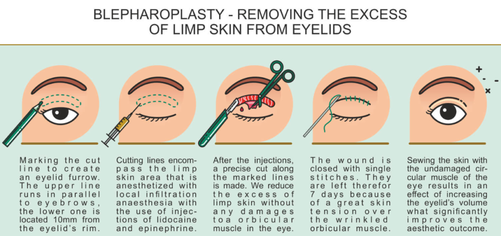 Blepharoplasty: Understanding Eyelid Surgery and Its Benefits